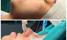 El Hospital Central ‘Dr. Ramón Carrillo’ realizó la primera cirugía ortognática