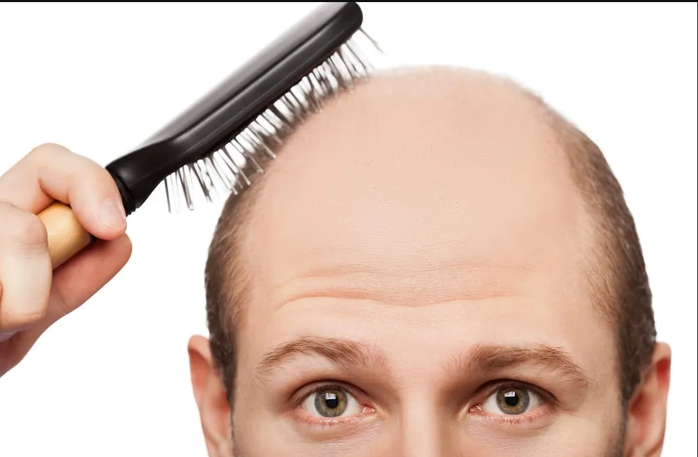 Lee más sobre el artículo Día del Pelado: que tan efectivos son los tratamientos que prometen recuperar el cabello perdido