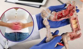 Advierten sobre el aumento del cáncer de colon en personas jóvenes: cuáles son los síntomas de alarma